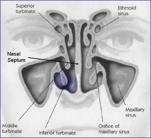 Turbinates Reduction