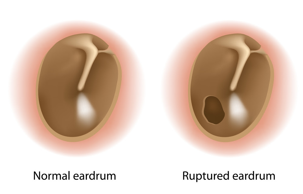 myringoplasty-repairing-the-eardrum-the-right-nose