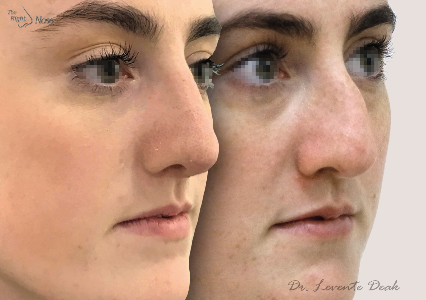 Female Curving nose The right nose