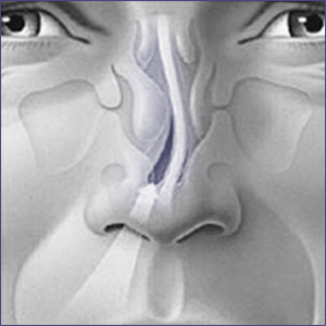 what-is-septoplasty