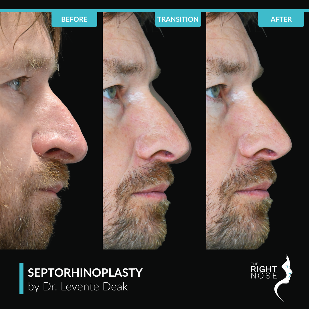 Septorhinoplasty