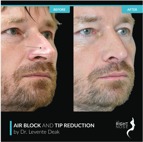 airblock and tip reduction