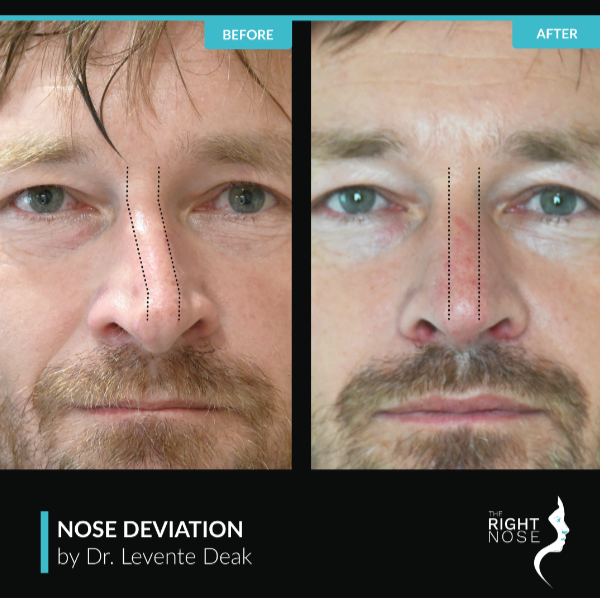 nose deviation