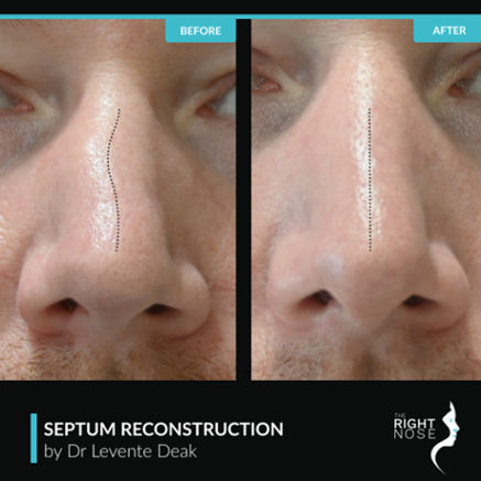 a close-up of a person's nose before and after septum surgery done by Dr Levente Deak the nest nose surgeon in Dubai