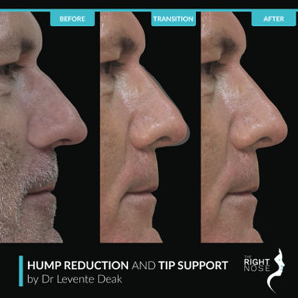 Hump Reduction Surgery: What to Expect, Benefits, and Recovery