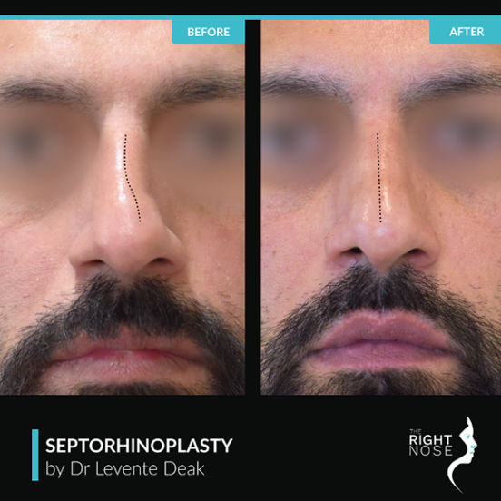befor and after image of deviated septum surgery dubai