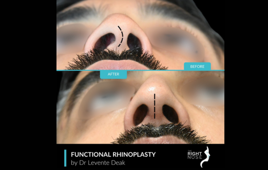 trauma nose