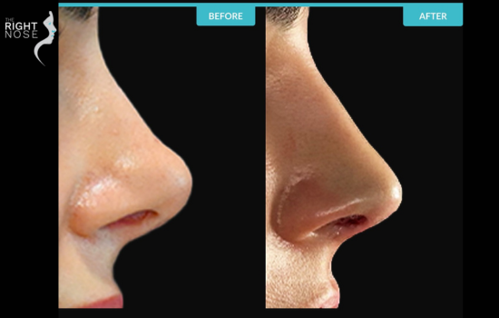 3 Signs You Need a Revision Septoplasty to Fix Breathing Problems