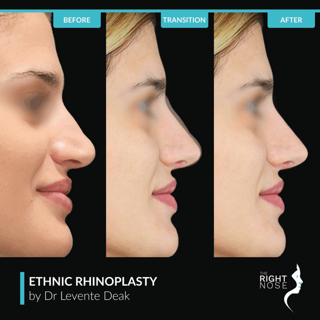 Ethnic rhinoplasty