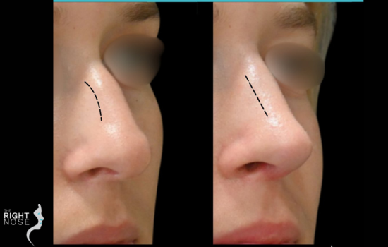 Functional rhinoplasty