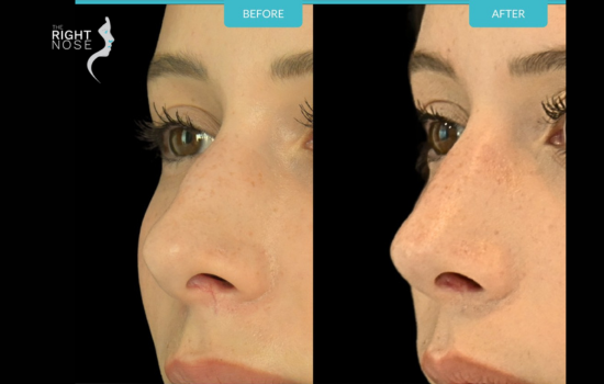 When a Second Nasal Surgery Can Finally Help You Breathe Better 1 1