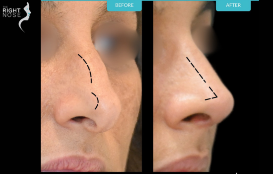 Aging rhinoplasty
