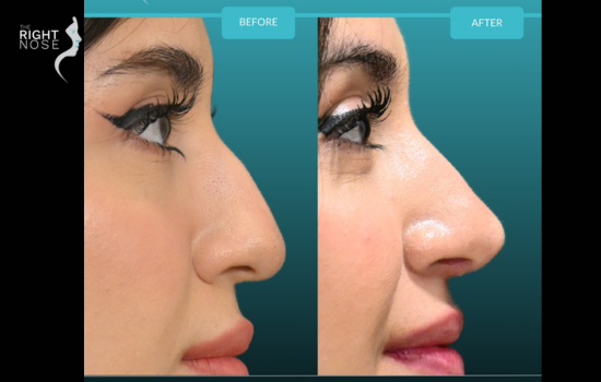 Understanding rhinoplasty for teenagers