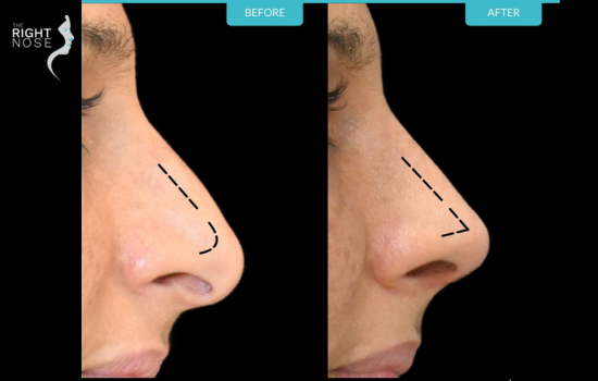 The Impact of Aging on Nasal Airway Function
