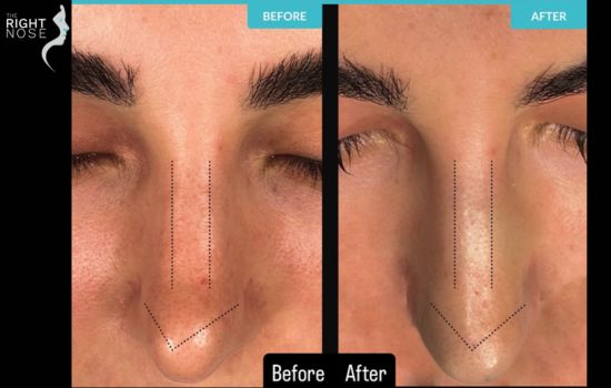 Common reasons patients seek Revision Rhinoplasty