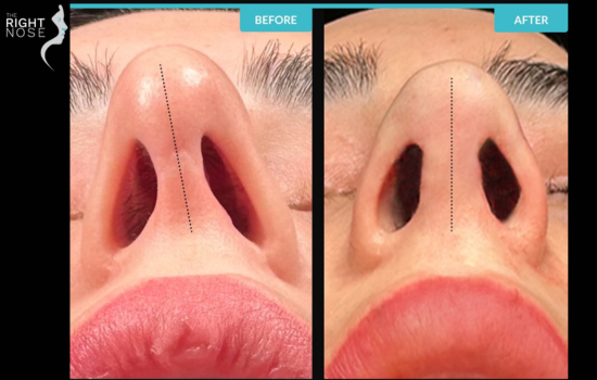 Revision Rhinoplasty Success Rate: What You Need to Know