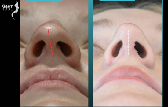 Open vs. Closed Rhinoplasty: Which is Better