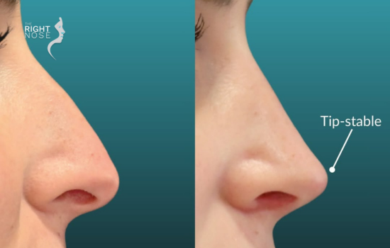 Rhinoplasty swelling stages and recovery: What to expect