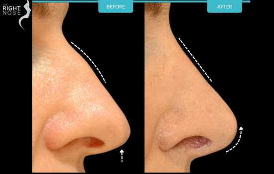 Aesthetic nose surgery( Rhinoplasty)