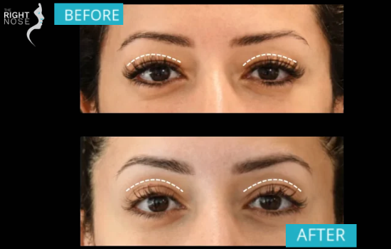 Blepharoplasty recovery timeline & tips
