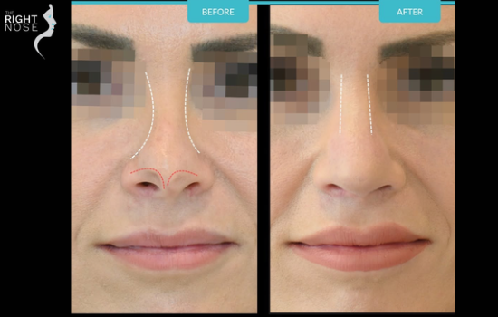 Two Types of Rhinoplasty Explained – Cosmetic vs Functional