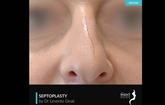Therightnose (2)