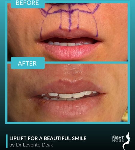 lip lift- Dr Levente Deak